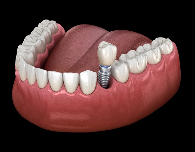Dental Implants