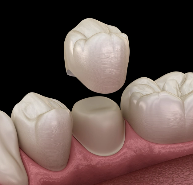 Restore and Protect Your Teeth With Durable Crowns