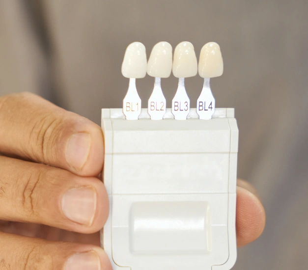 natural-looking veneers