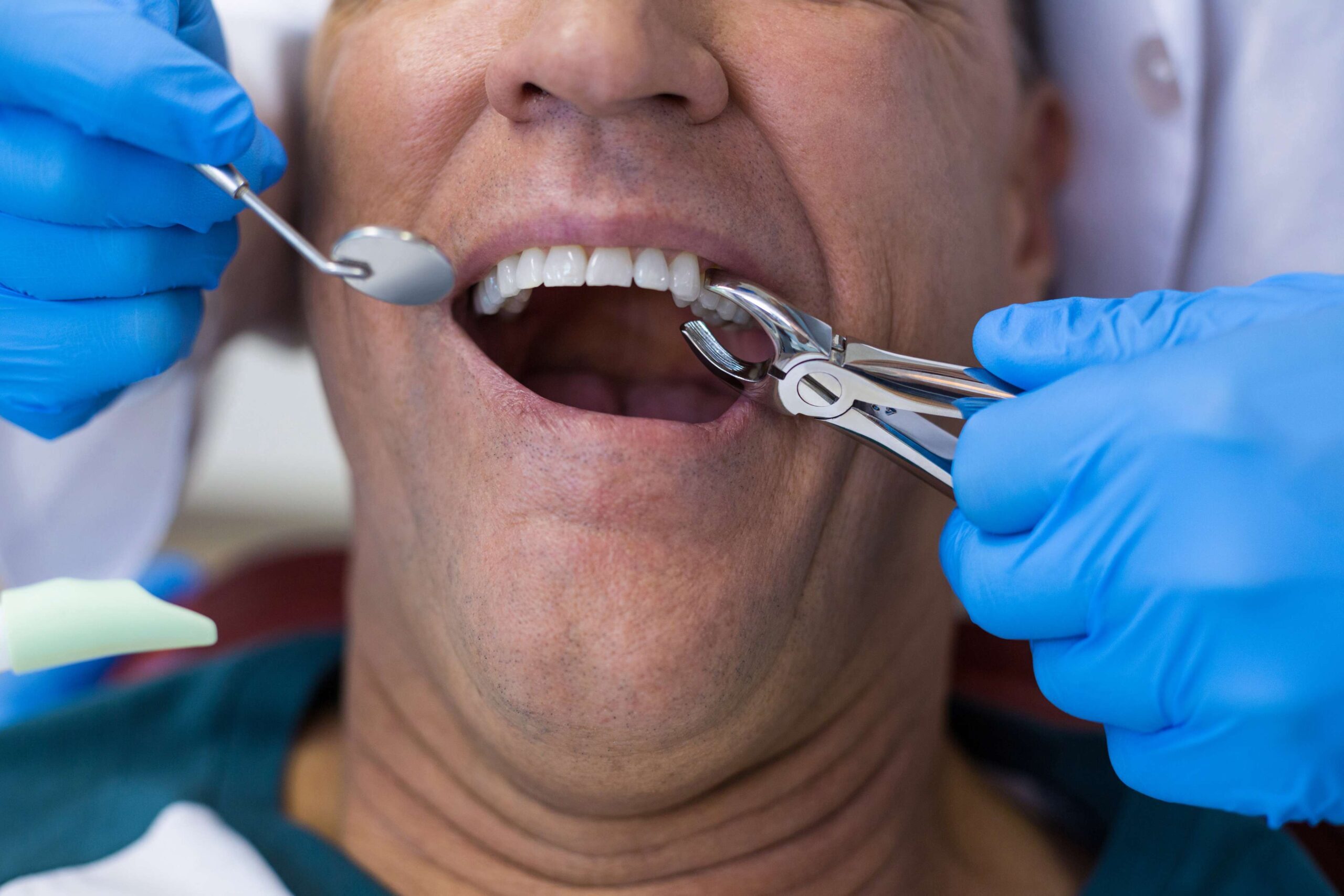 Dentist extracting tooth from patient using forceps during dental procedure.